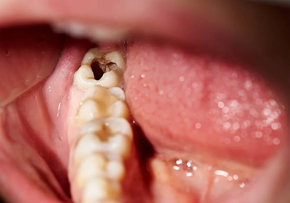 أعراض تسوس الأسنان
